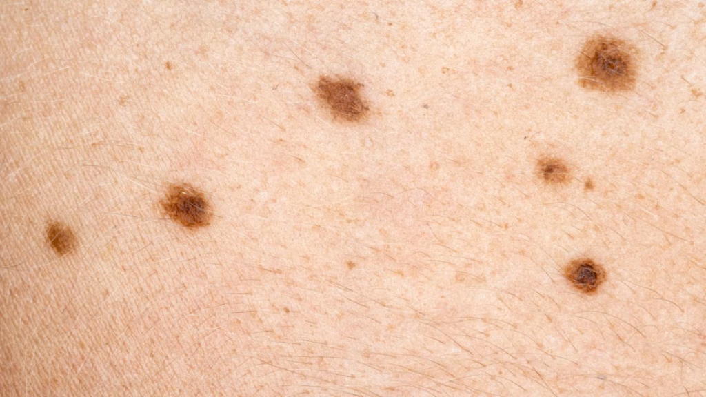 Six moles on a close-up photo of skin. 
